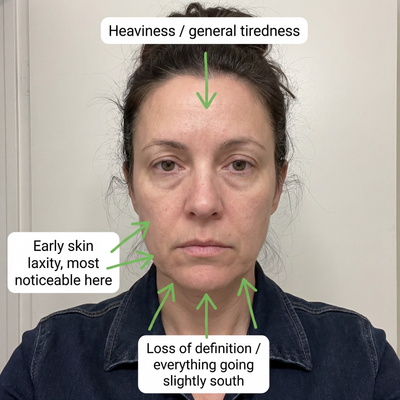 3. Loss of Definition